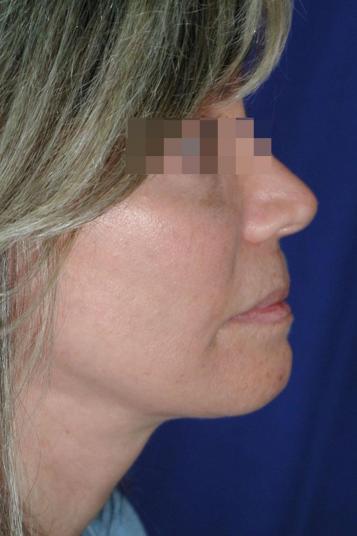 Face and Neck Rejuvenation Case 6505, After Treatment, Female Patient, Set 4