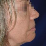 Face and Neck Rejuvenation Case 6505, Before Treatment, Female Patient, Thumbnail 4