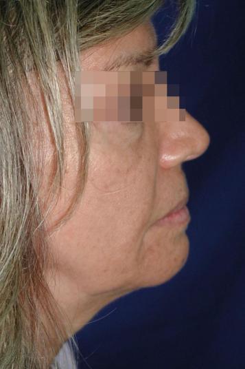 Face and Neck Rejuvenation Case 6505, Before Treatment, Female Patient, Set 4