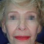 Face and Neck Rejuvenation Case 6560, After Treatment, Female Patient, Thumbnail 1