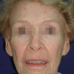 Face and Neck Rejuvenation Case 6560, Before Treatment, Female Patient, Thumbnail 1