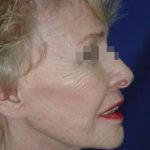Face and Neck Rejuvenation Case 6560, After Treatment, Female Patient, Thumbnail 2