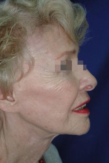 Face and Neck Rejuvenation Case 6560, After Treatment, Female Patient, Set 2
