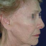 Face and Neck Rejuvenation Case 6560, Before Treatment, Female Patient, Thumbnail 2