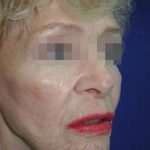 Face and Neck Rejuvenation Case 6560, After Treatment, Female Patient, Thumbnail 3