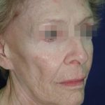 Face and Neck Rejuvenation Case 6560, Before Treatment, Female Patient, Thumbnail 3