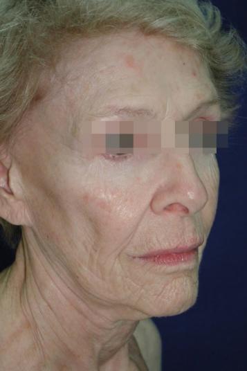 Face and Neck Rejuvenation Case 6560, Before Treatment, Female Patient, Set 3