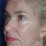Face and Neck Rejuvenation Case 6548, After Treatment, Female Patient, Thumbnail 1
