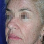 Face and Neck Rejuvenation Case 6548, Before Treatment, Female Patient, Thumbnail 1