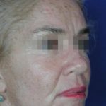 Face and Neck Rejuvenation Case 6548, After Treatment, Female Patient, Thumbnail 2
