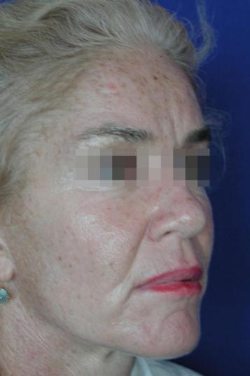 Face and Neck Rejuvenation Case 6548, After Treatment, Female Patient, Set 2