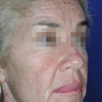 Face and Neck Rejuvenation Case 6548, Before Treatment, Female Patient, Thumbnail 2