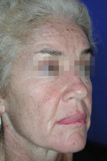 Face and Neck Rejuvenation Case 6548, Before Treatment, Female Patient, Set 2