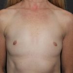 Breast Augmentation Case 6757, Before Treatment, Female Patient, Thumbnail 1