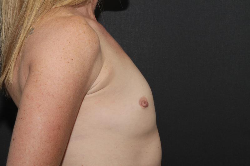Breast Augmentation Case 6757, Before Treatment, Female Patient, Set 5