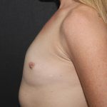 Breast Augmentation Case 6757, Before Treatment, Female Patient, Thumbnail 3