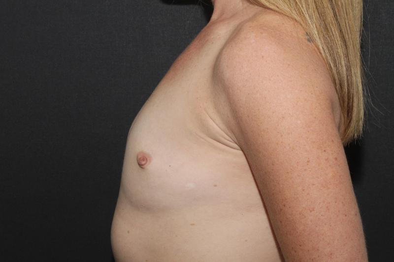 Breast Augmentation Case 6757, Before Treatment, Female Patient, Set 3