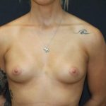Breast Augmentation Case 6760, Before Treatment, Female Patient, Thumbnail 1