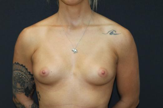 Breast Augmentation Before Photo