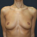 Breast Augmentation Case 6761, Before Treatment, Female Patient, Thumbnail 1