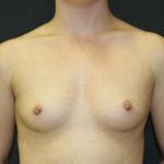 Breast Augmentation Case 6762, Before Treatment, Female Patient, Thumbnail 1