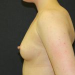 Breast Augmentation Case 6762, Before Treatment, Female Patient, Thumbnail 3