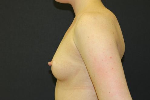 Breast Augmentation Case 6762, Before Treatment, Female Patient, Set 3