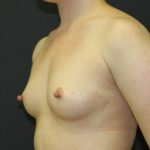 Breast Augmentation Case 6762, Before Treatment, Female Patient, Thumbnail 2