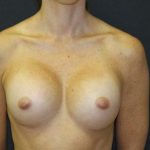 Breast Augmentation Case 6763, After Treatment, Female Patient, Thumbnail 1