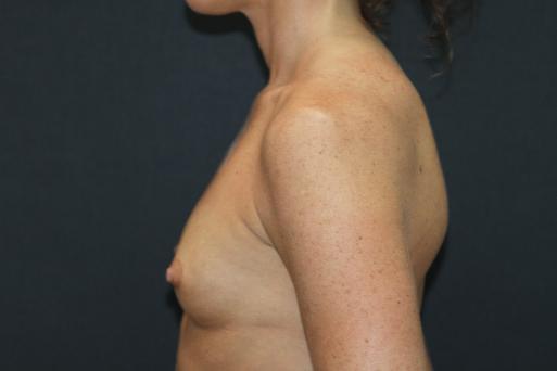 Breast Augmentation Case 6763, Before Treatment, Female Patient, Set 3