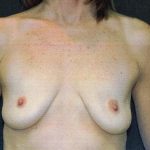 Breast Augmentation Case 6765, Before Treatment, Female Patient, Thumbnail 1