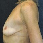 Breast Augmentation Case 6765, Before Treatment, Female Patient, Thumbnail 3