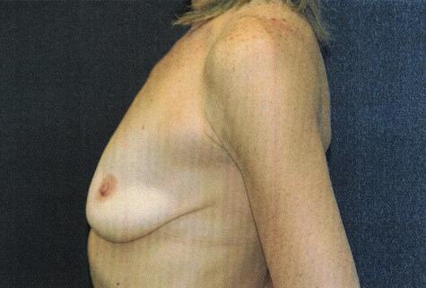 Breast Augmentation Case 6765, Before Treatment, Female Patient, Set 3