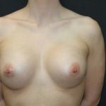 Breast Augmentation Case 6769, After Treatment, Female Patient, Thumbnail 1