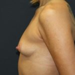 Breast Augmentation Case 6769, Before Treatment, Female Patient, Thumbnail 3