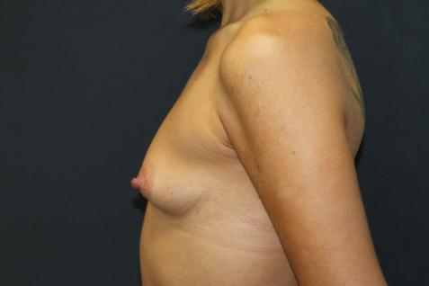 Breast Augmentation Case 6769, Before Treatment, Female Patient, Set 3