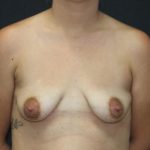 Breast Augmentation Case 6771, Before Treatment, Female Patient, Thumbnail 1