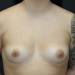Breast Augmentation Case 6775, Before Treatment, Female Patient, Thumbnail 1