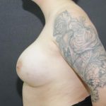 Breast Augmentation Case 6775, After Treatment, Female Patient, Thumbnail 3