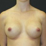 Breast Augmentation Case 6778, After Treatment, Female Patient, Thumbnail 1