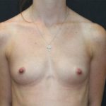 Breast Augmentation Case 6778, Before Treatment, Female Patient, Thumbnail 1