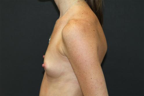 Breast Augmentation Case 6778, Before Treatment, Female Patient, Set 3