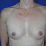 Breast Augmentation Case 6779, Before Treatment, Female Patient, Thumbnail 1