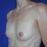 Breast Augmentation Case 6779, Before Treatment, Female Patient, Thumbnail 2