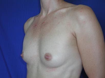 Breast Augmentation Case 6779, Before Treatment, Female Patient, Set 2