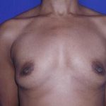 Breast Augmentation Case 6783, Before Treatment, Female Patient, Thumbnail 1