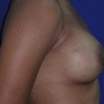Breast Augmentation Case 6783, After Treatment, Female Patient, Thumbnail 2