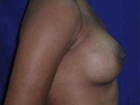Breast Augmentation Case 6783, After Treatment, Female Patient, Set 2