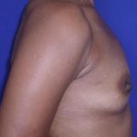 Breast Augmentation Case 6783, Before Treatment, Female Patient, Thumbnail 2