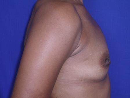 Breast Augmentation Case 6783, Before Treatment, Female Patient, Set 2